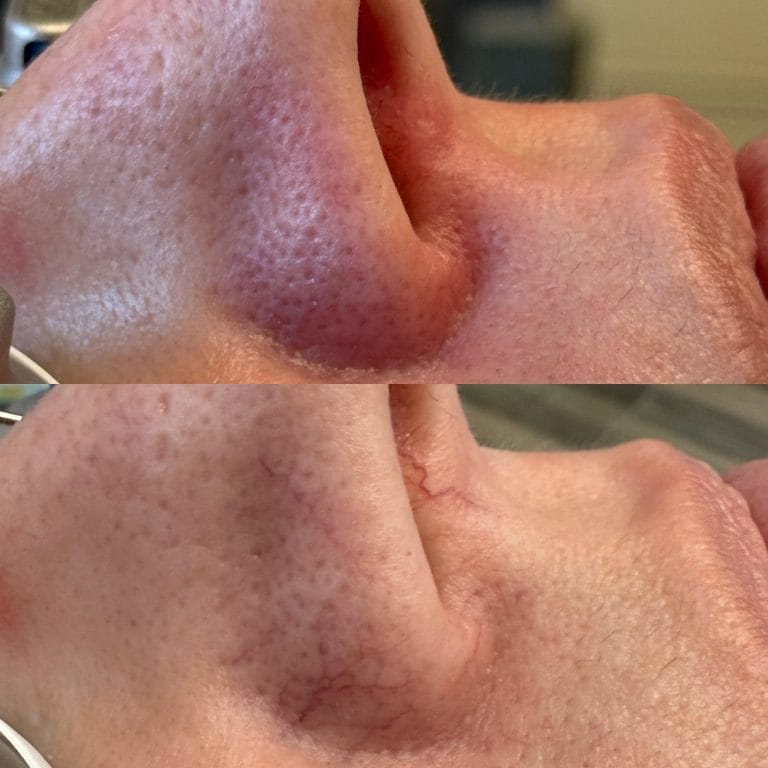nose-veins-face-boutique